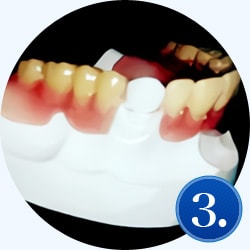 金具がなく、快適なノンクラスプ義歯に対応